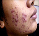 เรื่องสิว(Acne) ตอนสุดท้ายสิวประเภทต่างๆ