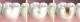 How tooth decay?